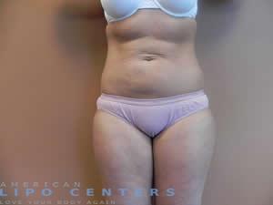 americanlipocenters_92.jpg